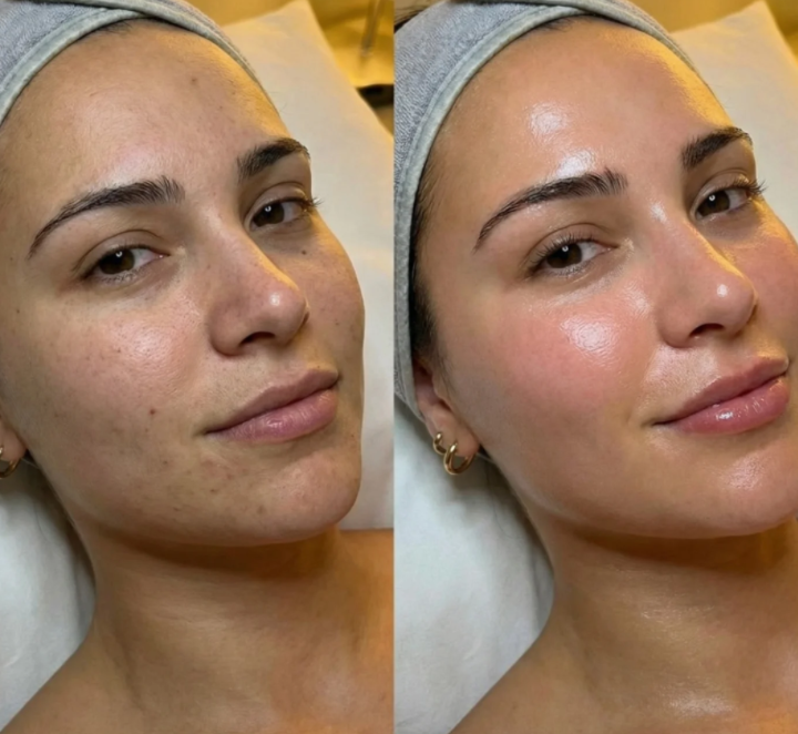 Improved skin texture and glow after a Hydrafacial treatment.